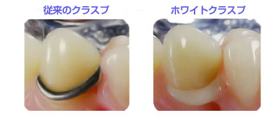 ホワイトクラスプ